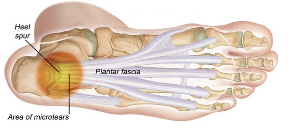 Understanding and Treating Plantar Fasciitis in Runners - The